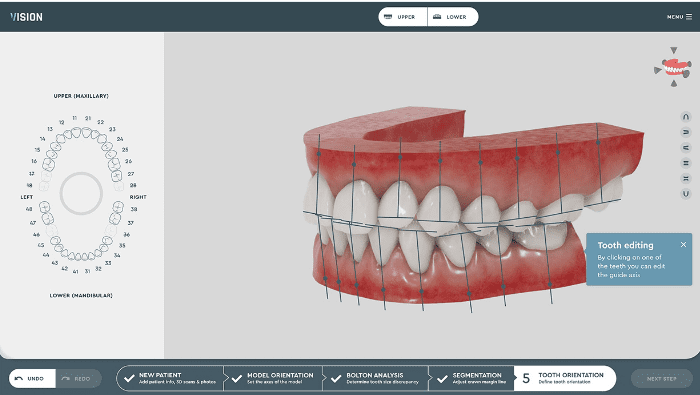 Orthodontic-Clear-Aligner-Treatment-Plan-Dentinova