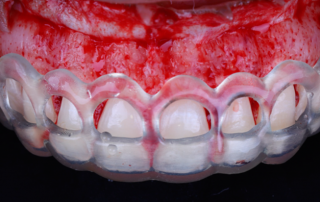 Dentinova-Gingivectomy-guide