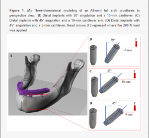 Effect-of-Angulation-of-posterior-implants-on-All-on-4-Full-arch-prosthesis