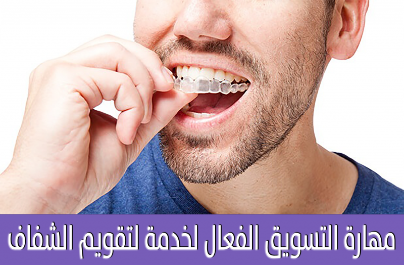 مهارة التسويق الفعال لخدمة لتقويم الشفاف - Dentinova